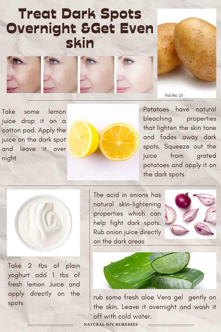 Black Spots On Face Remove Fast, How To Remove Dark Spots On Face, Black Spots On Face, Dark Spot Remover For Face, Facial Routine, Natural Skin Lightening, Hack My Life, Onion Juice, Dark Spots On Face