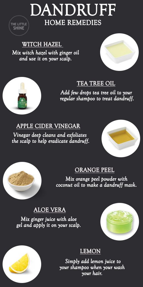 Alovera For Dandruff, How To Get Rid Of Hair Dandruff, How To Deal With Dandruff Dry Scalp, Dandruff Remedy Diy How To Get Rid, Instant Dandruff Removal, Get Rid Of Dandruff Naturally, What Helps With Dandruff, Dandruff Remedy For Locs, Causes Of Dandruff