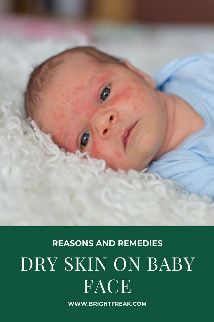 a baby laying on top of a white blanket with the words dry skin on baby face