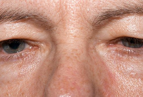 drooping eyelids Drooping Eyelids, High Cholesterol, Eye Health, Body Health, Immune System, Health Food, Your Eyes, Muscles, Health Tips