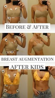 the before and after pictures of a woman's breast implants are shown in four different ways