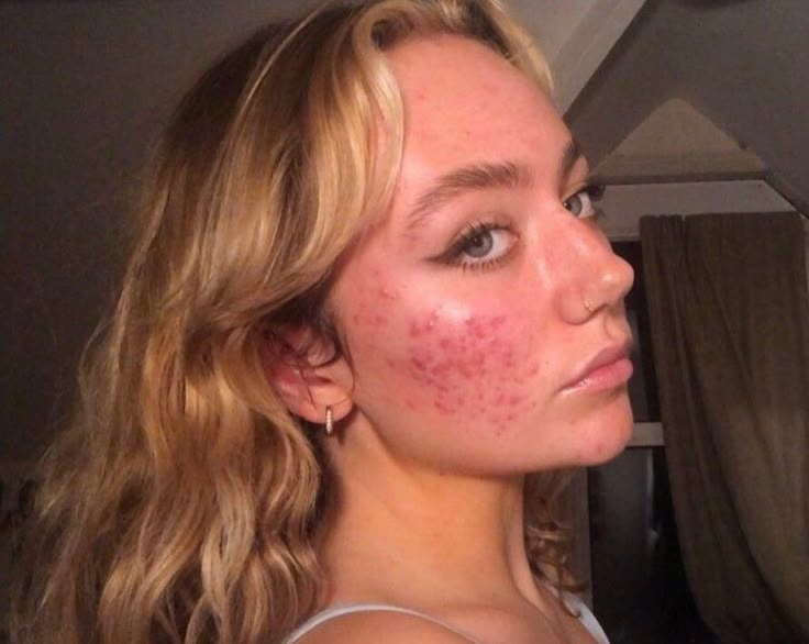 Pretty People With Acne, Girls With Acne, Acne Appreciation, Strawberry Freckles, Acne Is Beautiful, Acne Positive, Acne Is Normal, Acne Pictures, Girl With Acne