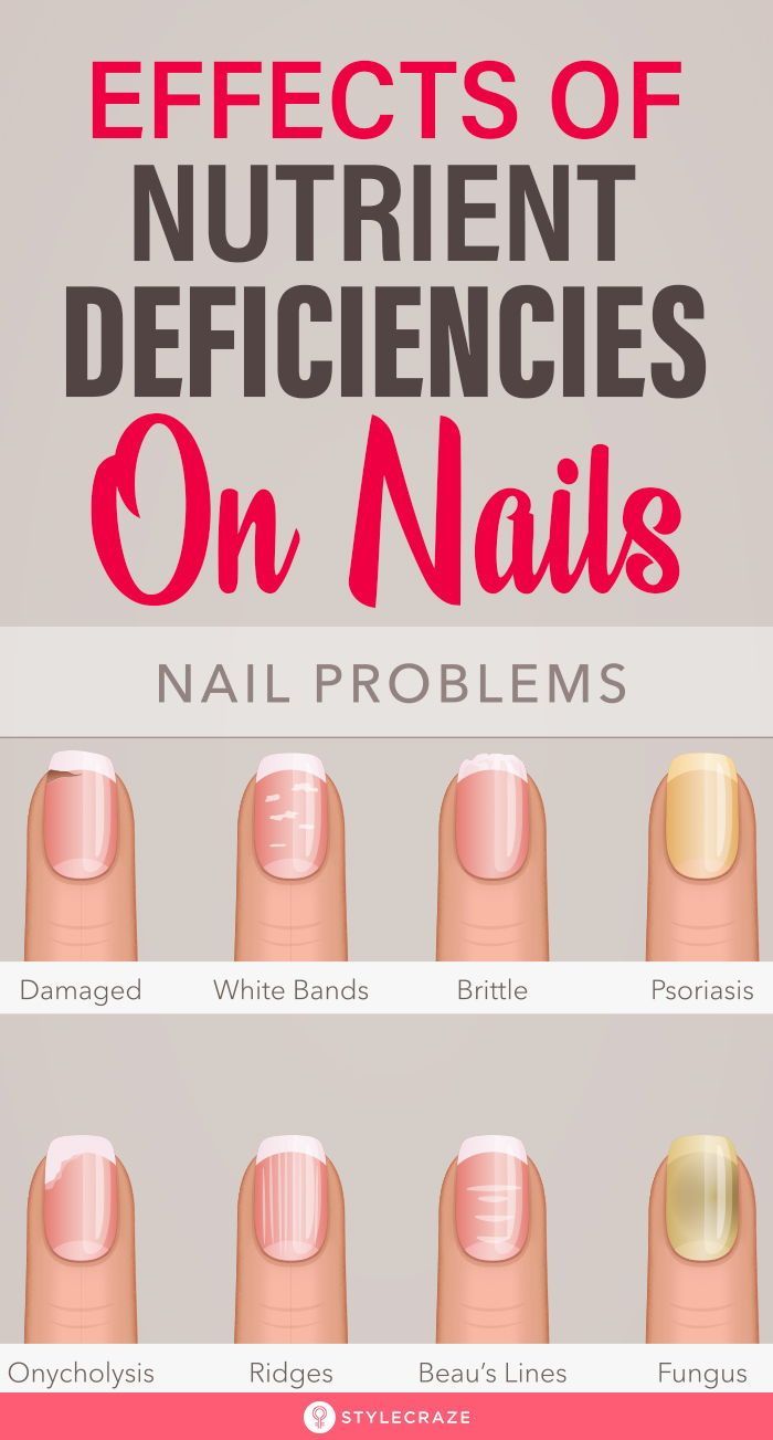 Effects Of Nutrient Deficiencies On Nails: Their shape, texture, color, growth rate – everything is a sign that your body is screaming for nutrients. Most of the changes in your nails and skin occur due to vitamin and nutrient deficiency. Here’s a list of symptoms that you may notice in your nails and what they mean for your health. #Nails #NailCare #NutritionDeficiency #NailCareTips Nail Health Signs, Nail Conditions, Nail Problems, Vitamin Deficiency, Health Signs, Tongue Health, Magnesium Deficiency, Nutrient Deficiency, Nail Care Tips