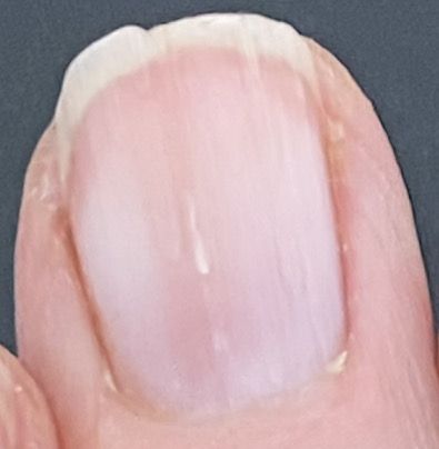 How To Stop Nails From Splitting, Repair Split Nail, Split Fingernails Remedies, Nail Splitting Down The Middle, How To Fix Split Nails, Nail Ridges Vertical Warning Signs, How To Fix A Split Fingernail, Splitting Nails Remedies, Finger Nails Health