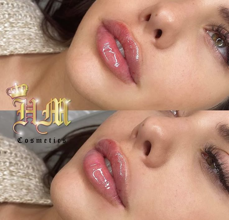 1.5 Lip Filler, Different Types Of Lip Fillers, Kendall Jenner Lip Fillers, Bratz Lip Filler, Babydoll Lip Filler, Angelina Jolie Lip Filler, Lip Filler Inspo 0.5ml, Lip Filler Shape Ideas Pouty, Lip Filler Inspo 1 Ml