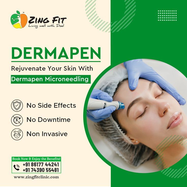 Say hello to a glowing complexion and wave goodbye to skin concerns with our Dermapen Microneedling Skin Treatment! 🌺✨ 👉 Book your Dermapen Microneedling session now and 🔓 unlock the beauty potential of your skin! Let your skin shine bright like never before at Zing Fit! 💆‍♀️💖 𝐅𝐨𝐫 𝐂𝐨𝐧𝐬𝐮𝐥𝐭𝐚𝐭𝐢𝐨𝐧 𝐂𝐚𝐥𝐥 𝐔𝐬 𝐎𝐧: 📲+91-8617744241​ 📲+91-7439055481 #ZingFit #LivingWellWithDoel #ZingFitClinic #DermapenMicroneedling #GlowingSkin #SkinRevival Dermapen Microneedling, Dream Physique, Skin Shine, Wave Goodbye, Live Fit, Your Best Self, Glowing Complexion, Confidence Boost, Skin Concern