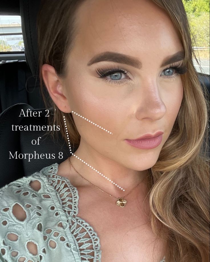 Skin Tightening and Remodeling with this amazing device. Combining Radio Frequency and Microneedling. Morpheus 8 Before And After, Snatched Jawline, Morpheus 8, Lip Augmentation, Beautiful Skin Care, Home Inside, Skin Care Clinic, Cosmetic Treatments, Chemical Peel