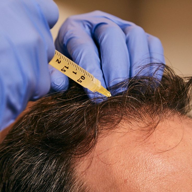 Stop hair loss with Platelet-Rich Plasma. Thousands of men are protecting their most valuable masculine assets through the new science of hair preservation using PRP.  https://hair.barbersurgeonsguild.com/platelet-rich-plasma/⠀ Medical Brand, Prp Hair, Platelet Rich Plasma, Hair Clinic, Photo Art Frame, Beauty Products Photography, Skin Clinic, Medical Spa, Med Spa