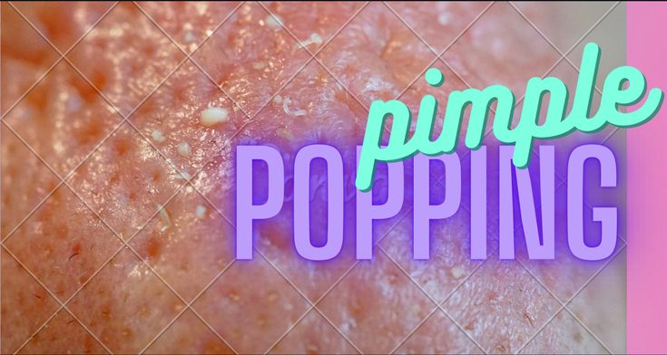 Satisfying Pimple Popping Deep Pimples Under Skin, Huge Pimple Poppìng, Satisfying Pimple Videos, Ear Pimple Poppìng Videos, Huge Pimple Pop Video, Big Pimple Poppìng Videos, Pimple Poppìng Videos New, Popping Pimples Videos, Cystic Pimple Pop