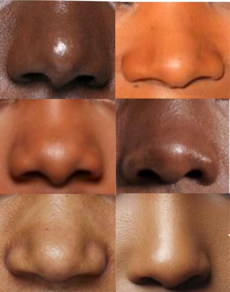 multiple images of different types of lips and nose shapes, all showing the same amount of lip fillers