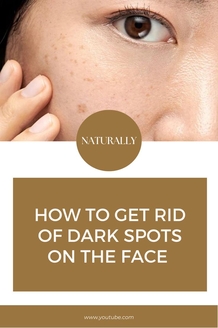 Best treatment for dark spots on face #Beauty #Wellness #Remedy Home Remedy For Dark Spots On Face, Dark Spots On Body How To Remove, Natural Dark Spot Remover For Face, Remedies To Remove Dark Spots On Skin, Facial Dark Spot Remedies, Dark Spots Remedies, Dark Spots On Face, Remove Dark Spots, Best Skin Care Routine