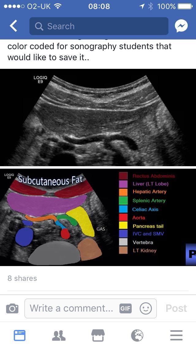 Ultrasound Technician School, Diagnostic Medical Sonography Student, Ultrasound School, Cardiac Sonography, Ultra Sound, Vascular Ultrasound, Sonography Student, Medical Sonography, Ultrasound Sonography