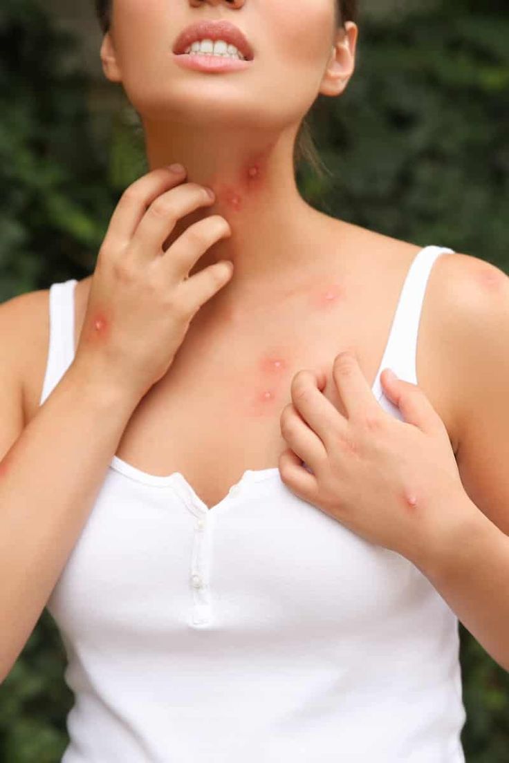 a woman is holding her hands on her chest and looking up at the sky with red spots all over her body