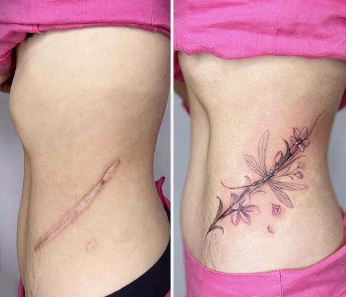 before and after photos of a woman's tummy surgery, showing the scar on her stomach