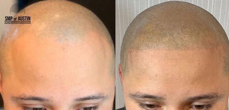 Women With Long Hair, Hair Problem, Scalp Micropigmentation, Pattern Hair, Bald Spot, Male Pattern Baldness, Hair Thinning, Fuller Hair, Hair Problems