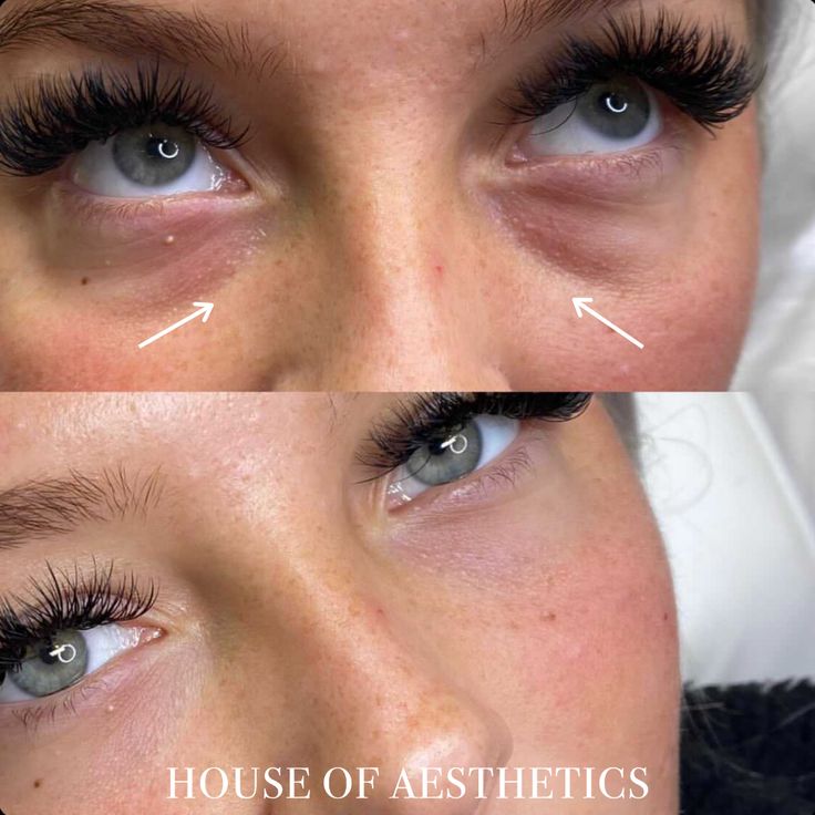 Eye Bag Filler, Trough Filler Before After, Tear Through Eye Filler, Tear Through Filler Before And After, Eye Trough Filler Before And After, Tear Trough Filler Before After, Under Eye Filler Before And After, Tear Trough Filler, Under Eye Filler