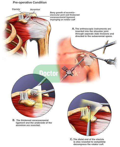 Shoulder Impingement Syndrome with Arthroscopic Surgery Decompression. This medical illustration series pictures the left shoulder with impingement syndrome. It also includes the arthroscopic surgical steps involved to release the shoulder and repair the anatomy. Arthroscopic Shoulder Surgery, Shoulder Anatomy, Rotator Cuff Surgery, Shoulder Dislocation, Shoulder Rehab, Shoulder Problem, Shoulder Impingement, Surgeon Doctor, Orthopedic Surgeon