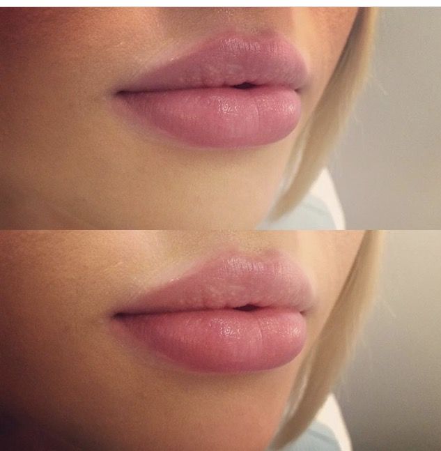 Beautiful lips maintained with 1/2 syringe by Laura Riehl-Tonn RN Pillow Lips Injections, 2 Syringes Of Lip Filler, Lip Filler 1 Syringe, Bottom Lip Filler, 1 Syringe Lip Filler Before And After, 1 Ml Lip Filler, Lip Injections Shapes, 1 Syringe Lip Filler, 1ml Lip Filler