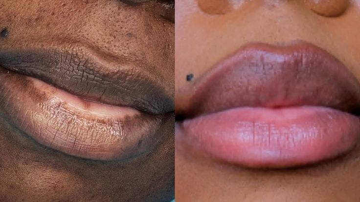 Lip Fillers On Black Women, Lip Neutralization, Lip Color Tattoo, Blush For Dark Skin, For Dark Lips, Lip Permanent Makeup, Home Remedies For Warts, Warts Remedy, Dark Lip