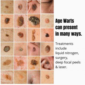 Phenol Peel, Seborrheic Keratosis, Flat Warts, Autoimmune Disease Symptoms, Types Of Warts, Facial Warts, Remove Skin Tags Naturally, Remove Warts, Wart Remover