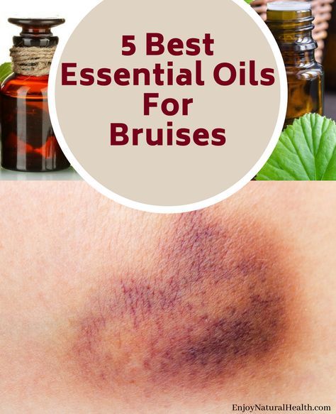 Essential Oil For Bruising, Essential Oils For Pain, The Healing Process, Essential Oil Remedy, Essential Oils Cleaning, Oil Remedies, Young Living Oils, Doterra Oils, Best Essential Oils