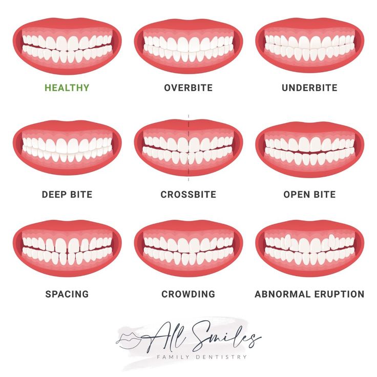 Straight Teeth With Braces, Straighten Teeth Without Braces, Perfect Smile Teeth, Teeth Correction, Teeth Problems, Dental Animation, Braces Pain, Myofunctional Therapy, Braces Tips