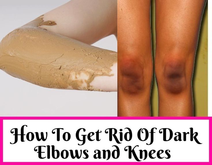 Dark Elbows And Knees, Coconut Oil Massage, Best Hair Serum, Dry Elbows, Dark Elbows, Apply Coconut Oil, Potato Juice, Getting Rid Of Dandruff, Dark Underarms