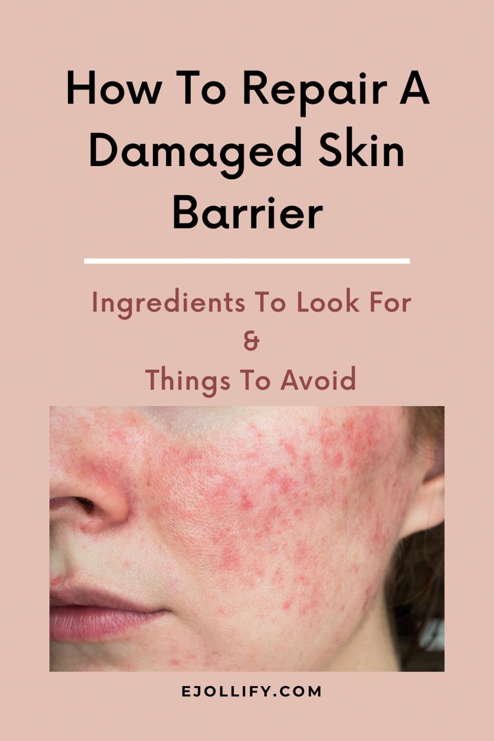 Skin Repair Remedies, How To Know If Your Skin Barrier Is Damaged, How To Fix Damaged Skin Barrier, Compromised Skin Barrier, Heal Skin After Picking, How To Heal Skin Barrier, Moisture Barrier Skin Care, How To Restore Skin Barrier, Heal Skin Barrier