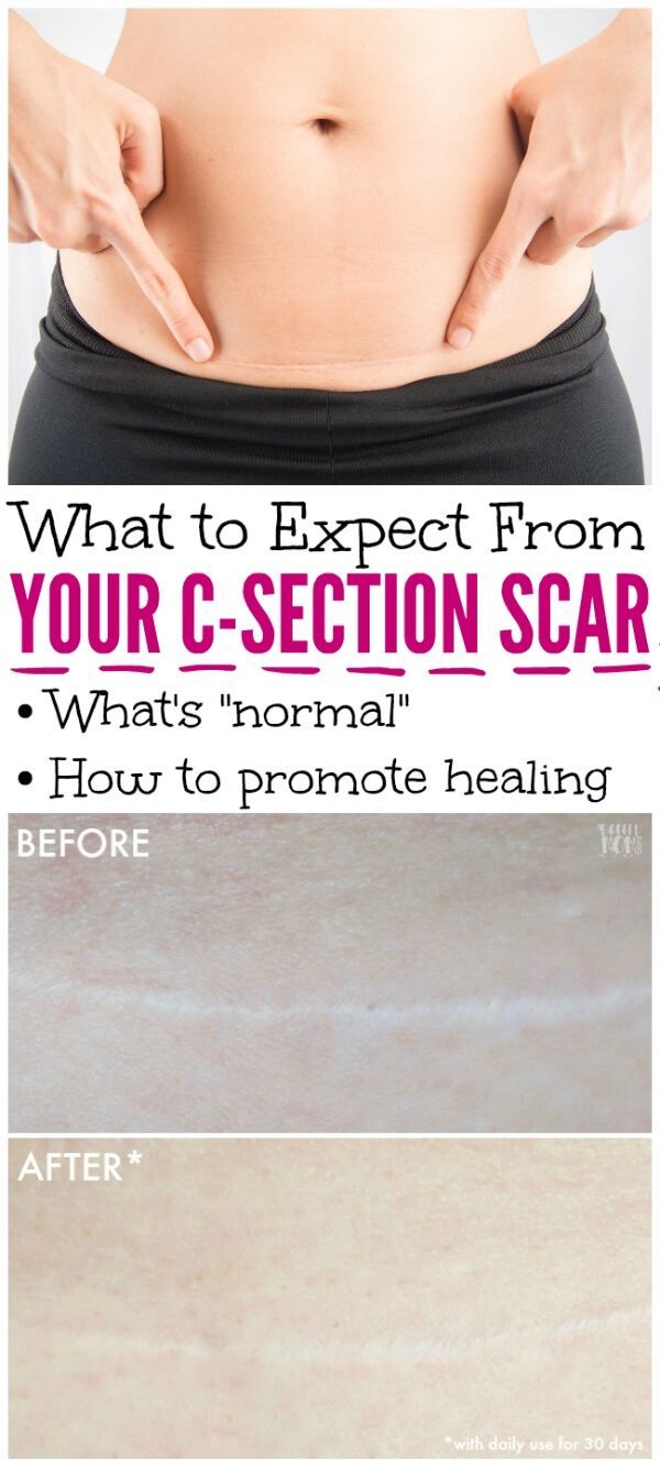 a woman's stomach with the words what to expect from your c - section scar