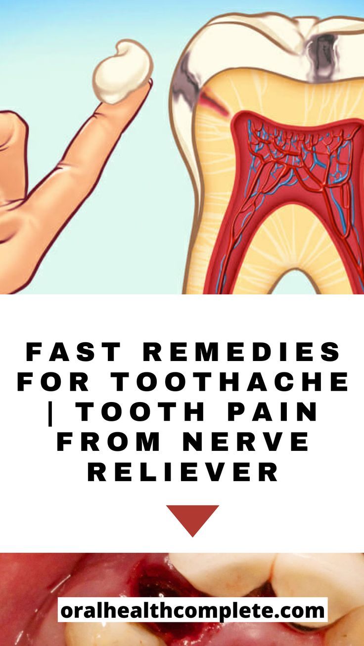 Fast Remedies For Toothache | Tooth Pain From Nerve Reliever Cavity Pain, Cavity Remedy, Toothache Relief, Tooth Pain Remedies, Nerve Pain Remedies, Tooth Pain Relief, Tooth Nerve, Tooth Ache Relief, Remedies For Tooth Ache