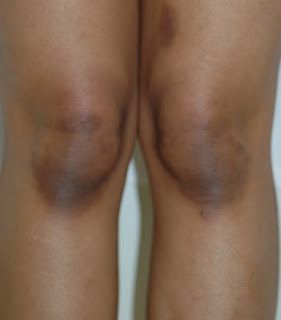 Lighten Dark Knees, Dark Knees, Natural Skin Lightening, Skin Lightener, Skin Pigmentation, Beauty Remedies, Skin Remedies, Skin Discoloration, Diy Skin