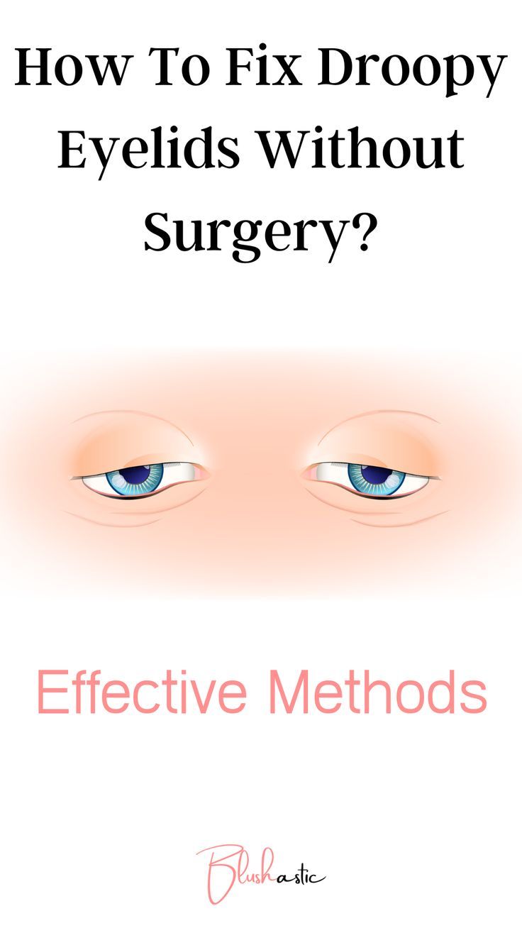 Though there are various surgical methods to fix these droopy eyelids, some people might not prefer going under the knife. If you are in this situation too and wonder, ‘How to fix droopy eyelids without surgery?’ then you are at the right place. Fix Droopy Eyelids, Makeup For Droopy Eyelids, Saggy Eyes, Eyelid Wrinkles, Saggy Eyelids, Drooping Eyelids, Homemade Wrinkle Cream, Droopy Eyelids, Droopy Eyes