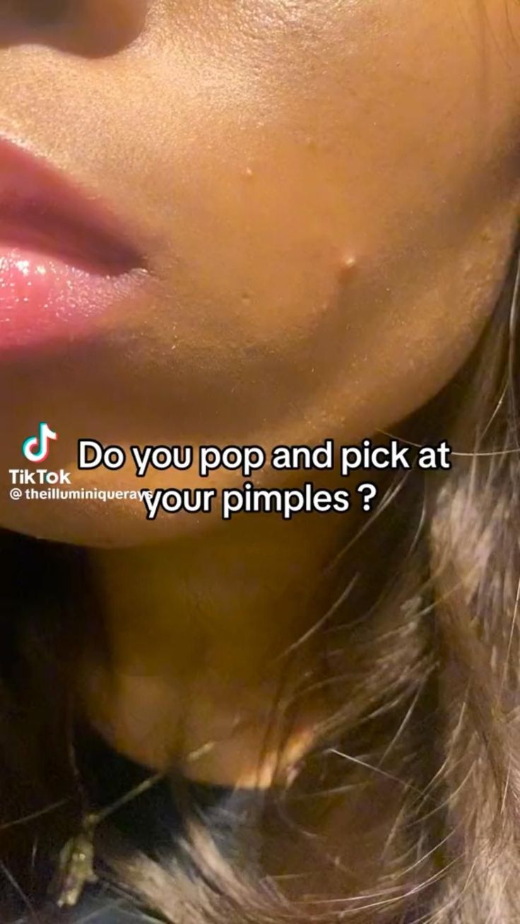 Get rid of pimples Getting Rid Of Scars, Regular Skin Care Routine, How To Clear Pimples, Get Rid Of Pimples, Rid Of Pimples, Forehead Acne, Pimple Scars, How To Get Rid Of Pimples, Best Skin Care Routine