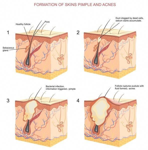 Acne is a disorder of the pilosebaceous units in the skin. These are found most abundantly in the skin over the face, the upper chest, and the back. They are responsible for the growth of skin hair in addition to the lubrication of the skin. Whiteheads Remedy, Skin Anatomy, Forehead Acne, Integumentary System, Acne Overnight, Health Medicine, Natural Acne Remedies, Acne Serum, Preventative Health