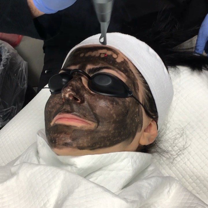 Laser Peel, Laser Facial, Laser Resurfacing, Laser Skin, Skin Resurfacing, Celebrity Skin, Peeling Skin, Skin Rejuvenation, Black Doll