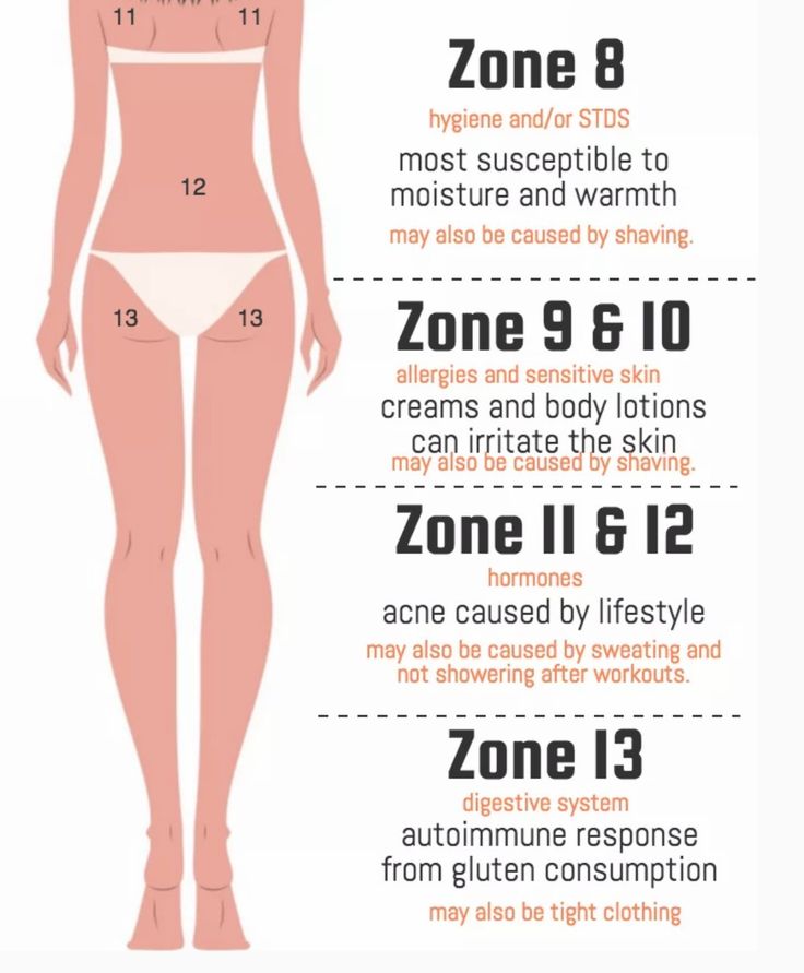 Acne body mapping Body Acne Map, Acne Map, Remedies For Back Acne, Body Points, Back Acne Remedies, Body Mapping, Cleaning Your Ears, Back Acne, Remedies For Acne