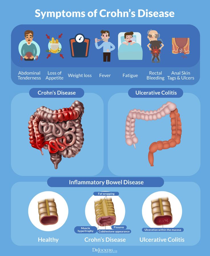 Natural Solutions to Crohn's Disease - DrJockers.com Chrones Disease, Crohns Symptoms, Crohns Diet, Chrons Disease, Irritable Bowel Disease, Muscle Hypertrophy, The Digestive System, Disease Symptoms, Hormonal Balance