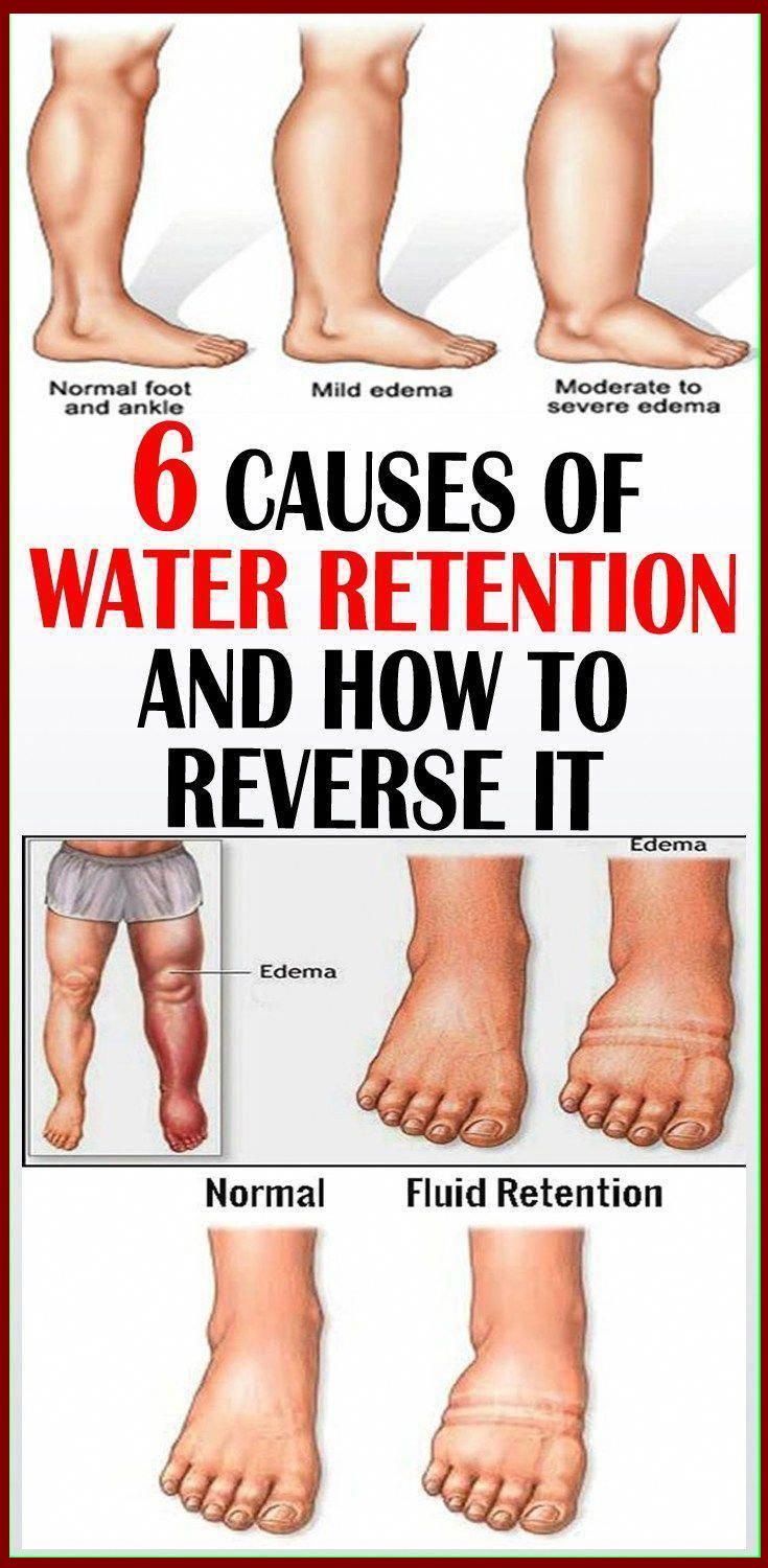 6 Ways To Reduce Water Retention Reduce Water Retention, Water Retention Remedies, Summer Health, Fluid Retention, Water Retention, Healthy Beauty, Good Health Tips, Healthy Food Choices, Healthy Eating Tips