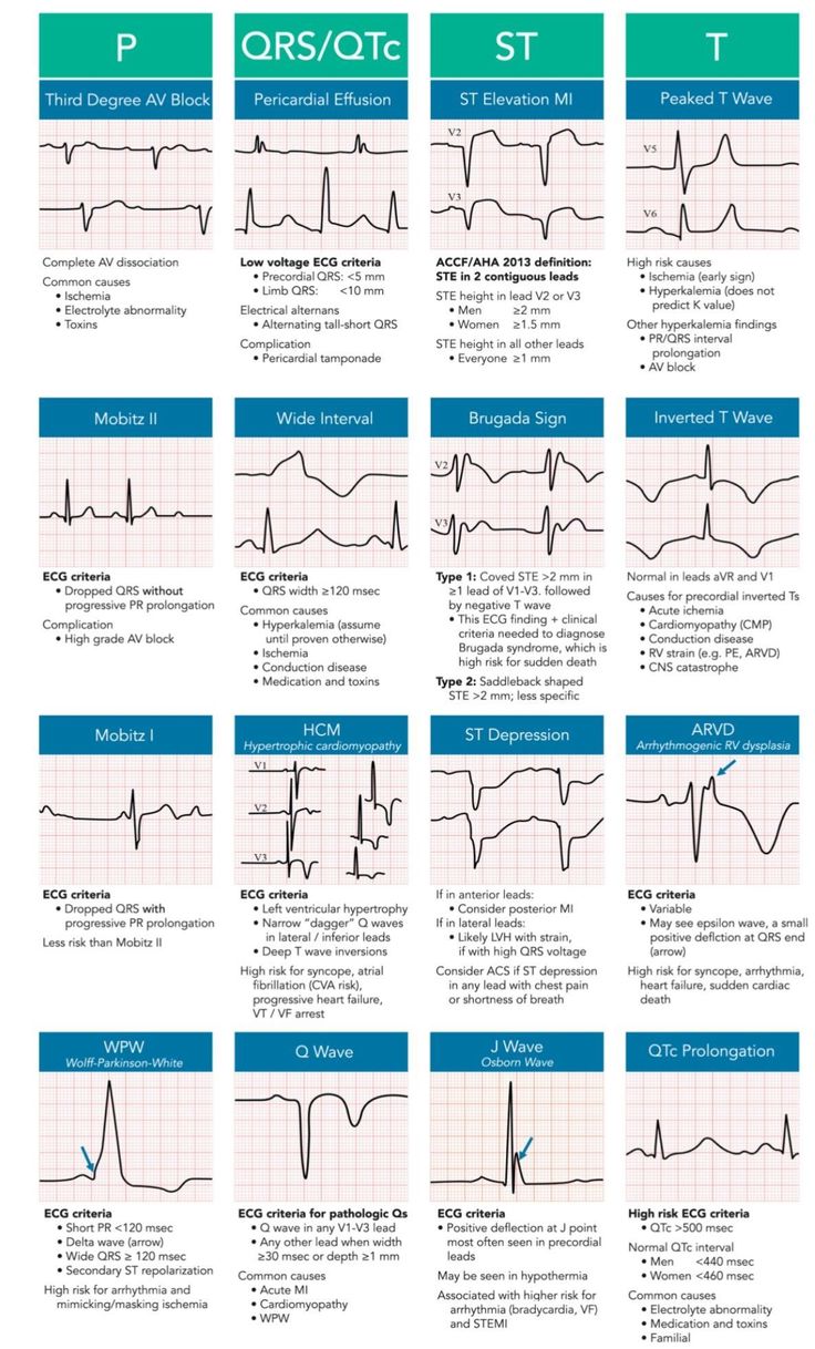 Cardiology Nursing, Ekg Interpretation, Paramedic School, Nursing School Essential, Nurse Study Notes, Nursing Student Tips, Cardiac Nursing, Critical Care Nursing, Pa School