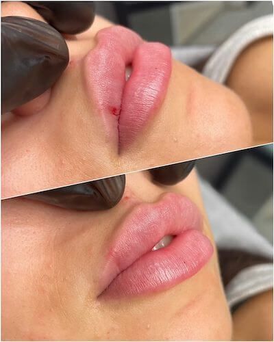 Madeline Cline Lip Filler, Sarah Cameron Lip Filler, Heavy Upper Lip Filler, Lip Filler For Uneven Lips, Lip Filler Heavy Upper Lip, Key Hole Lip Filler, Madelyn Cline Lip Fillers, Lip Filler Types, Russia Lip Filler