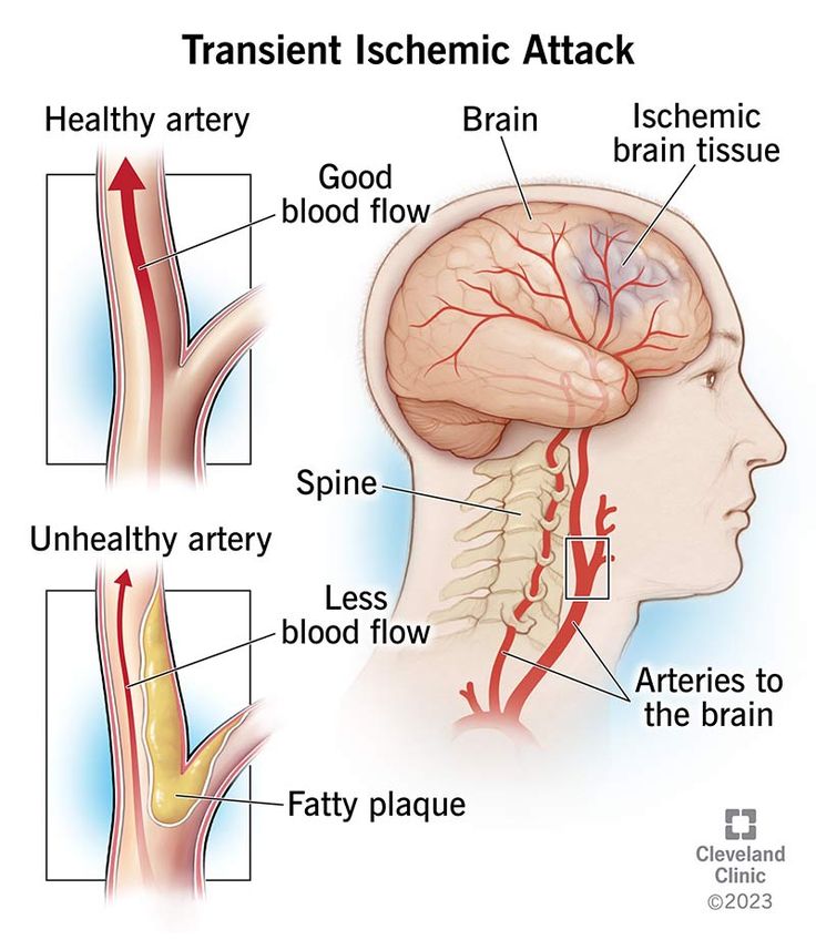 Transient ischemic attack: Don’t ignore the warning Food For Heart, Yoga Information, Physical Inactivity, Carotid Artery, Medical Emergency, Brain Tissue, Cleveland Clinic, Joints Pain Relief, The Warning