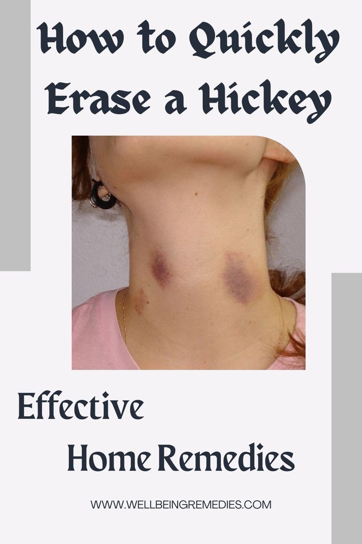 How To Get Rid Of Hickeys, How To Get Rid Of A Hickey Fast, How To Cover A Hickey Fast, How To Remove Hickey Fast, How To Get Rid Of Hickeys Quickly, Best Places To Leave Hickeys, Hickey Removal Quick, Get Rid Of Hickies, Hickey Mark