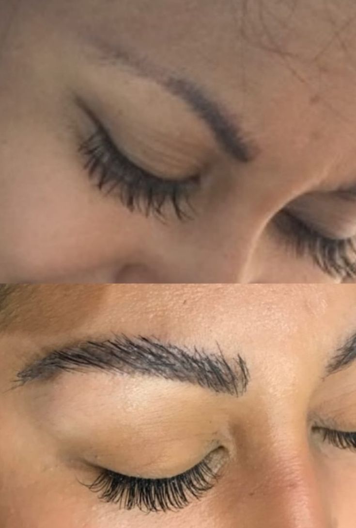 Microblading VS Eyebrow Hair Transplant Brow Transplant, 90s Eyebrows, Dark Circle Removal, Eyebrow Hair Transplant, Thicker Eyebrows, Eyebrow Transplant, Aesthetic Dermatology, Beauty Eyebrow, Hair Transplant Surgery