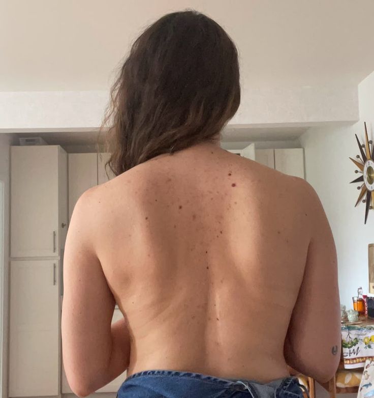 I Finally Conquered My Back Acne Scars At 32 — Here's How I Did It Body Acne Scar Remedies, Back Scarring, Clear Back Acne, Back Acne Scar Removal, Back Acne, Shoulder Acne, Acne Women, Fade Acne Marks, Scar Remedies