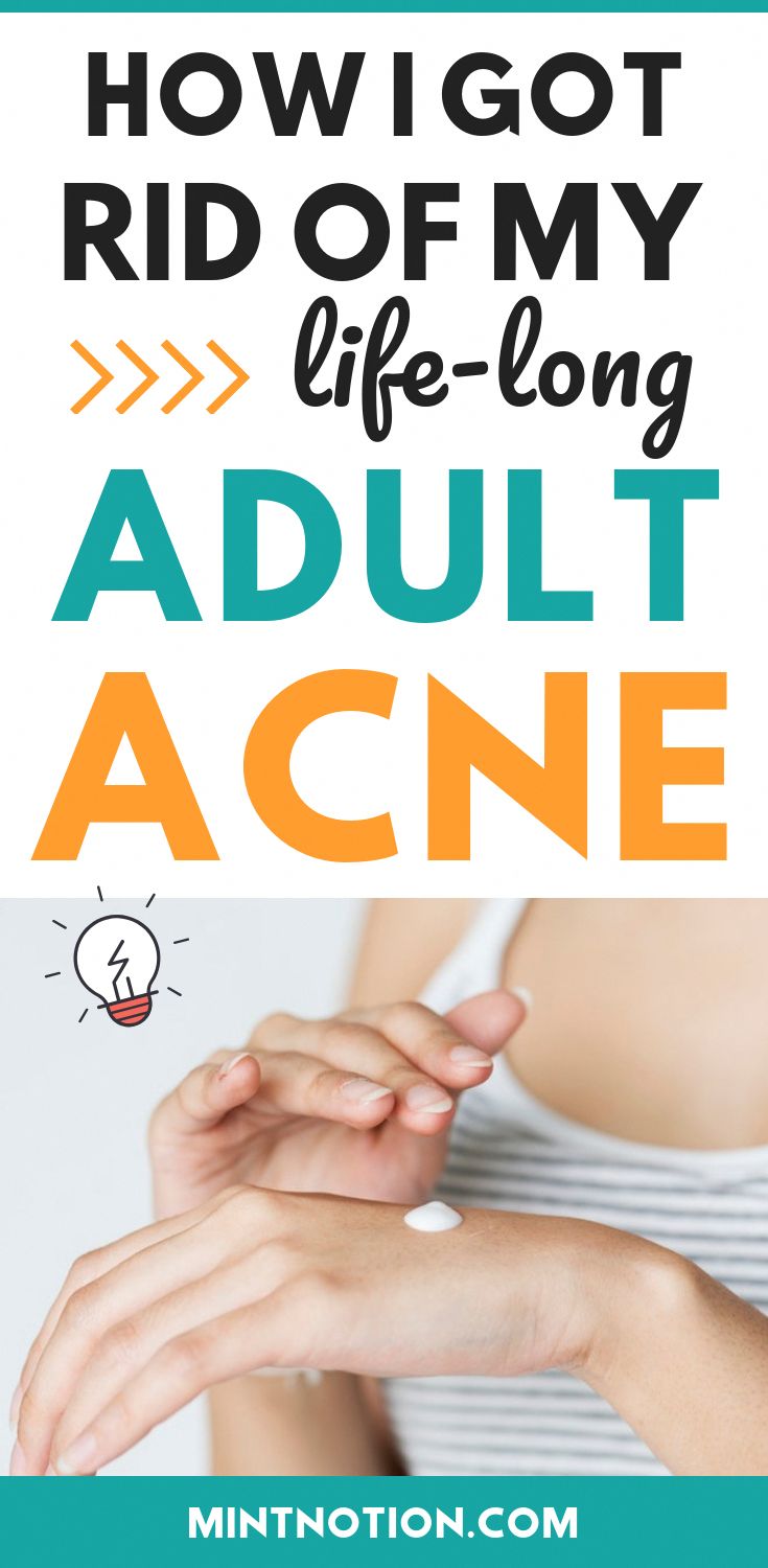 How I cured my adult acne. After trying perscription medication, antiboitoics, and skincare routines, I finally healed my acne. Clear skin is possible. Tips To Get Healthy, Rid Of Acne Overnight, Get Rid Of Acne Overnight, A Good Skincare Routine, Good Skincare Routine, Chest Acne, Good Skincare, Bad Acne, Acne Overnight