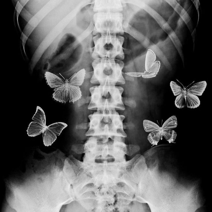 an x - ray shows butterflies flying around the neck