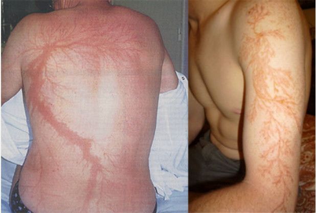 before and after photos of varicosity on the back of a man's body