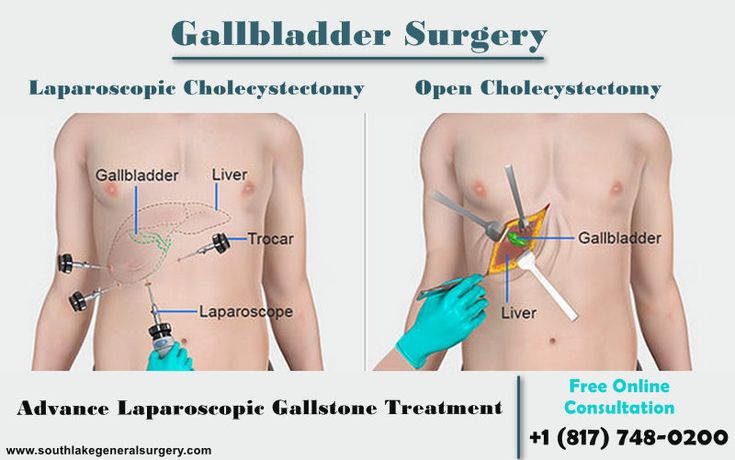 Gallbladder Removal Recovery, Gallbladder Removal Diet, Gallbladder Symptoms, After Gallbladder Surgery, Gallbladder Attack, Gallbladder Removal, Gallbladder Stones, Gallbladder Diet, Gallbladder Surgery