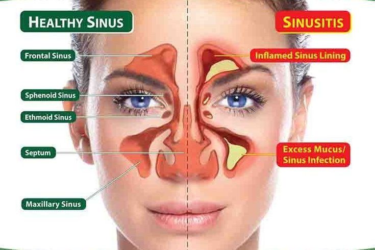 4 Easy Steps to Clear Sinuses Fast and Effectively Remedy For Sinus Congestion, Jus Lemon, Blocked Sinuses, Sinus Remedies, Home Remedies For Sinus, Maxillary Sinus, How To Clear Sinuses, Sinus Infection Remedies, Sinus Problems