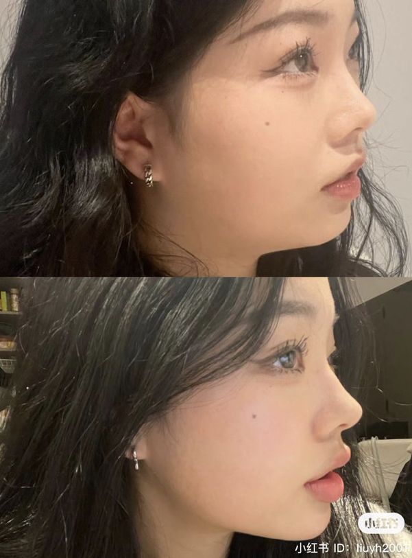 Perfect Side Profile, Lipo Before And After, Face Plastic Surgery, Nose Fillers, Chin Filler, Plastic Surgery Fail, Chin Implant, Botox Before And After, Rhinoplasty Nose Jobs